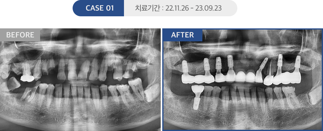 임플란트 케이스01