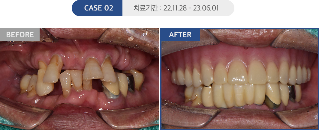 임플란트 케이스02