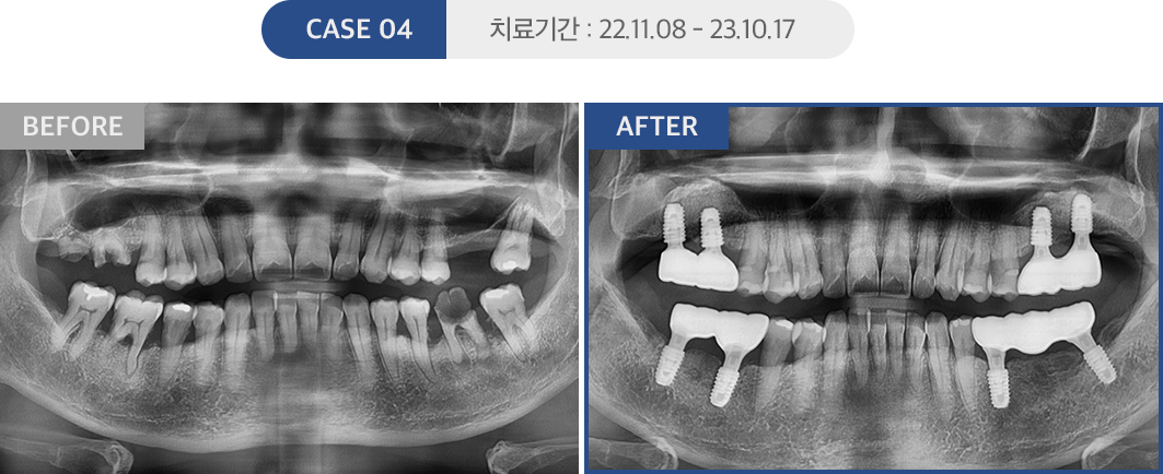 임플란트 케이스04