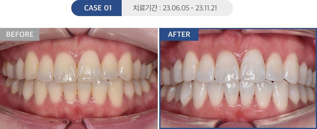 치아미백 케이스01