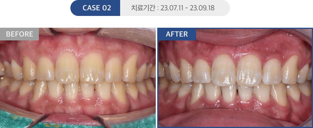 치아미백 케이스02