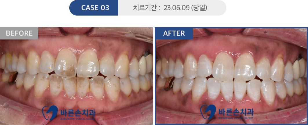 치아미백 케이스03