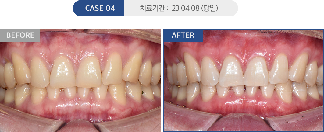 치아미백 케이스04