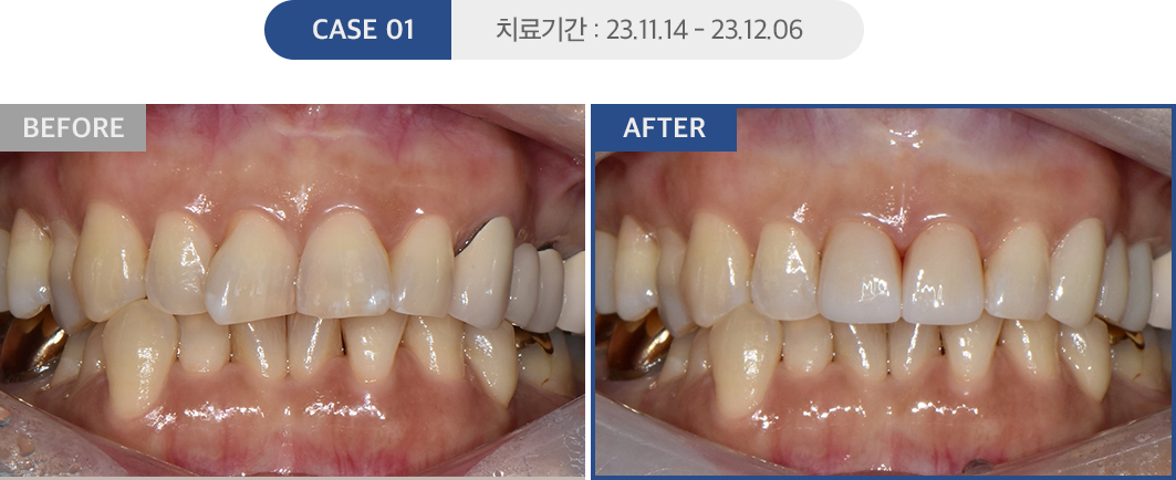 심미치료 케이스01
