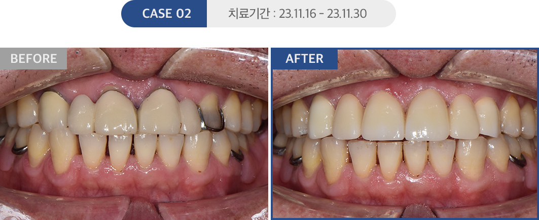 심미치료 케이스02